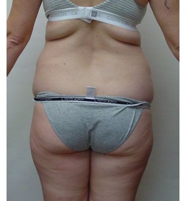 abdominoplasty back view before